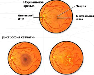 Distrofia retinei: simptome și metode de tratament