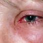 Výměna oční čočky - co je tato operace?
