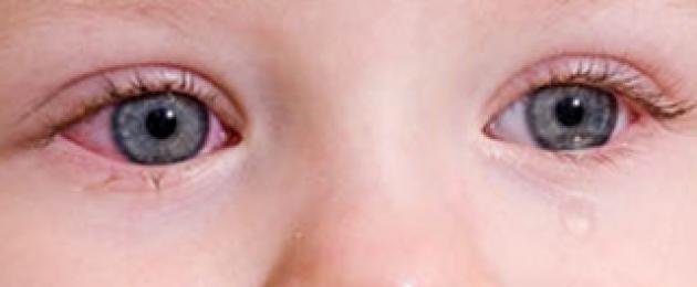 Gonfiore dell'occhio nelle cause infantili. Occhi gonfi nel bambino