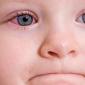 Опухлі очі у немовля