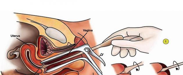 Pap test - čo to je, dekódovanie a špeciálne funkcie.  Aktuálny program cytologického skríningu rakoviny krčka maternice - výsledky, interpretácia Pap testu