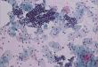 Cytological examination of smears (scobs) from the surface of the cervix (external uterine os) and cervical canal - preparation for Papanicolaou (Pap test) (mixed smear)